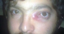 Göz hastalığının adı var, tedavisi yok!