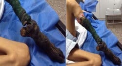 Yılan sokması sonucu 13 yaşındaki kızın ayağı bu hale geldi!