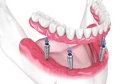 Tüm Ağız İmplant Tedavisi Nedir?